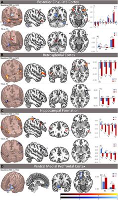 Treatment Effect of Long-Term Antipsychotics on Default-Mode Network Dysfunction in Drug-Naïve Patients With First-Episode Schizophrenia: A Longitudinal Study